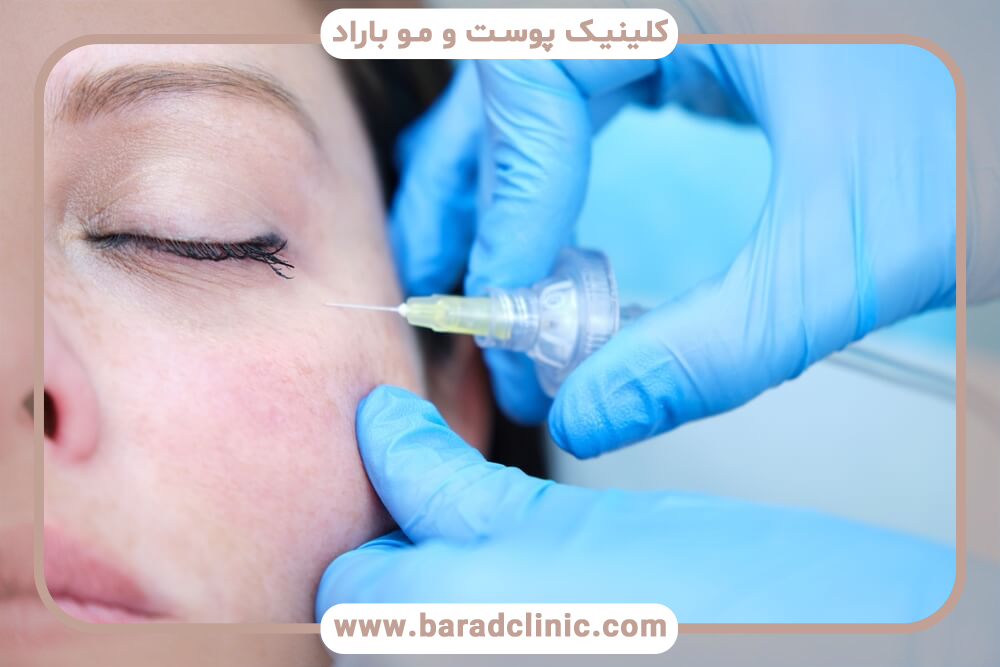 کربوکسی تراپی دور چشم چیست؟