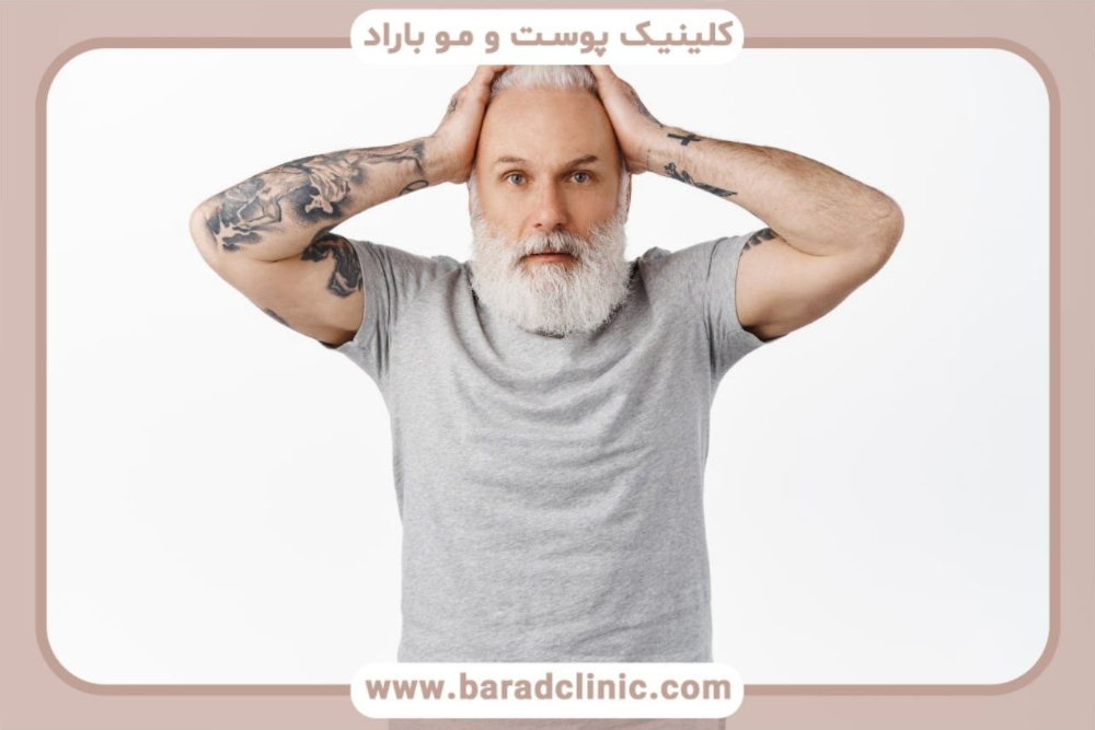 بهترین روش کاشت مو 
