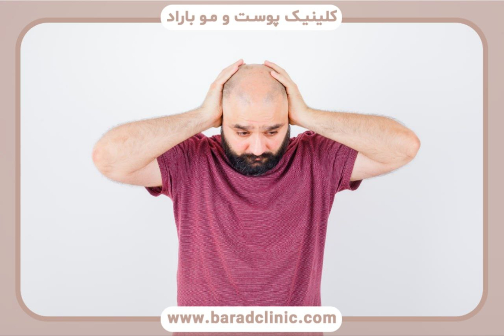 بهترین روش کاشت مو 