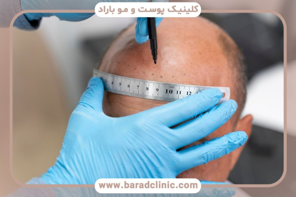 بهترین روش کاشت مو 