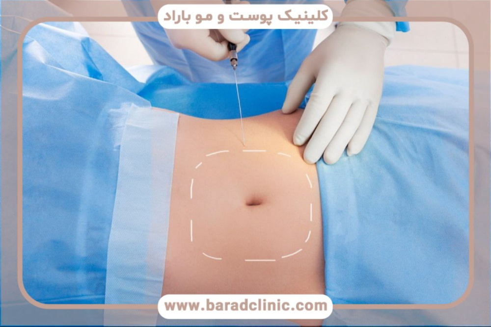جدیدترین روش‌های پیکرتراشی در ۲۰۲۴