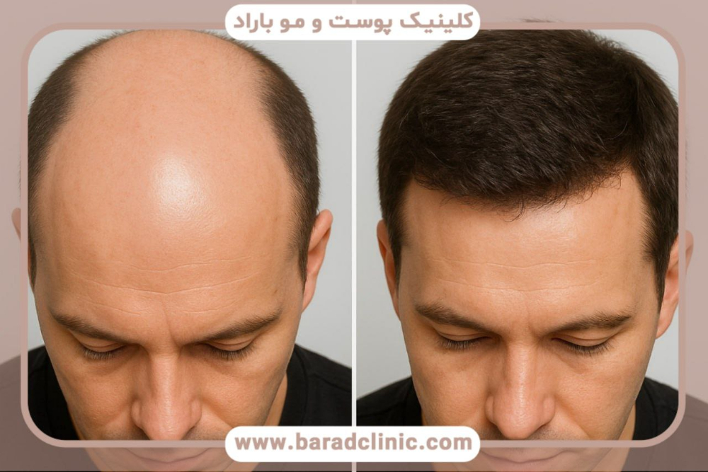 عکس ریزش مو بعد از کاشت