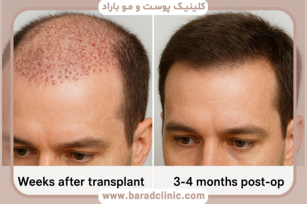 عکس ریزش مو بعد از کاشت