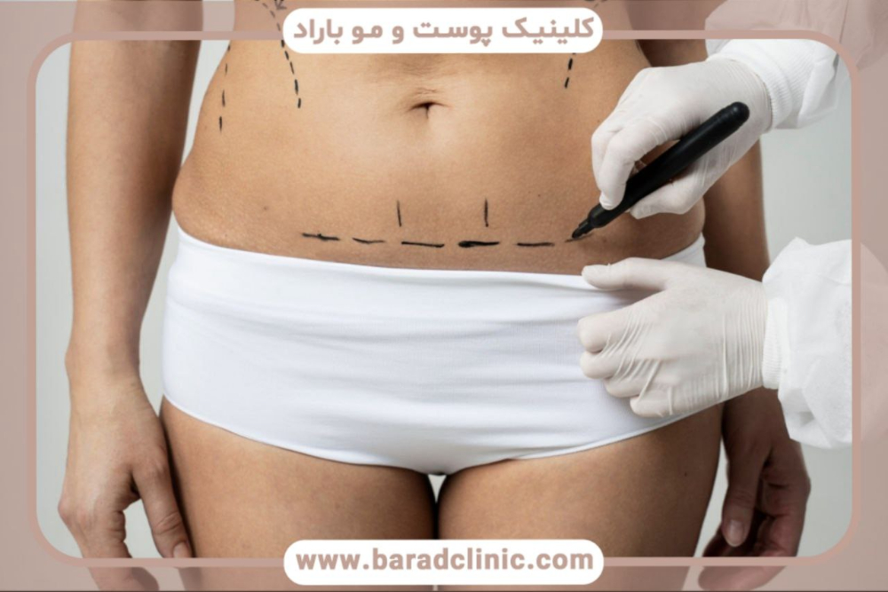 پیکرتراشی اولتراسونیک