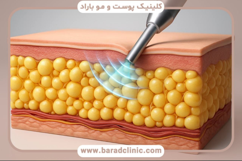 پیکرتراشی اولتراسونیک