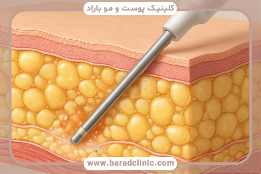  پیکرتراشی ساکشن کم‌تهاجمی