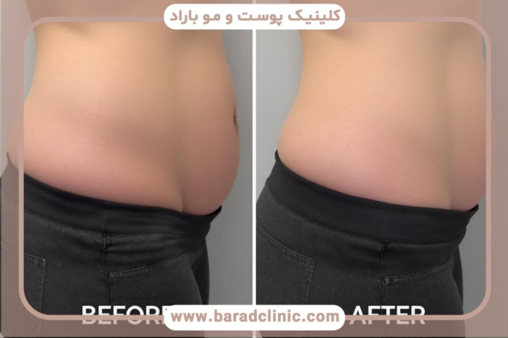 پیکرتراشی لیزری