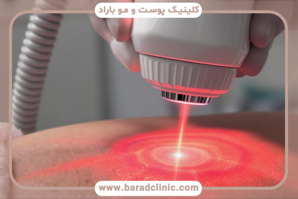 پیکرتراشی لیزری