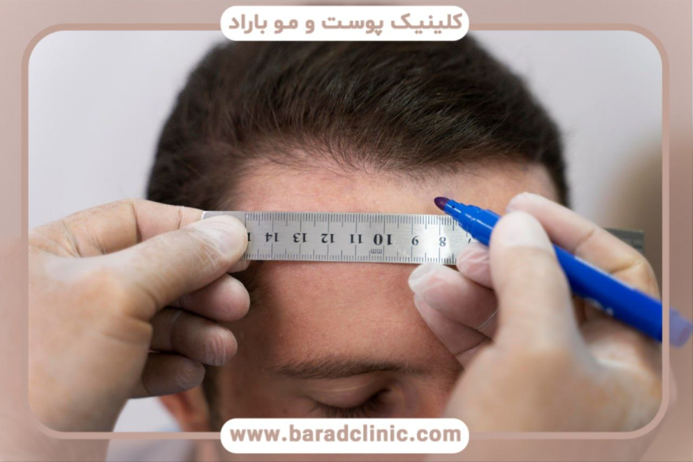 کاشت مو تهران