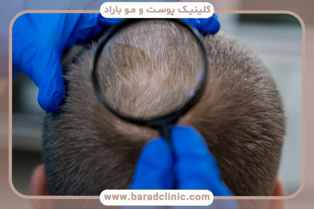 کاشت مو تهران