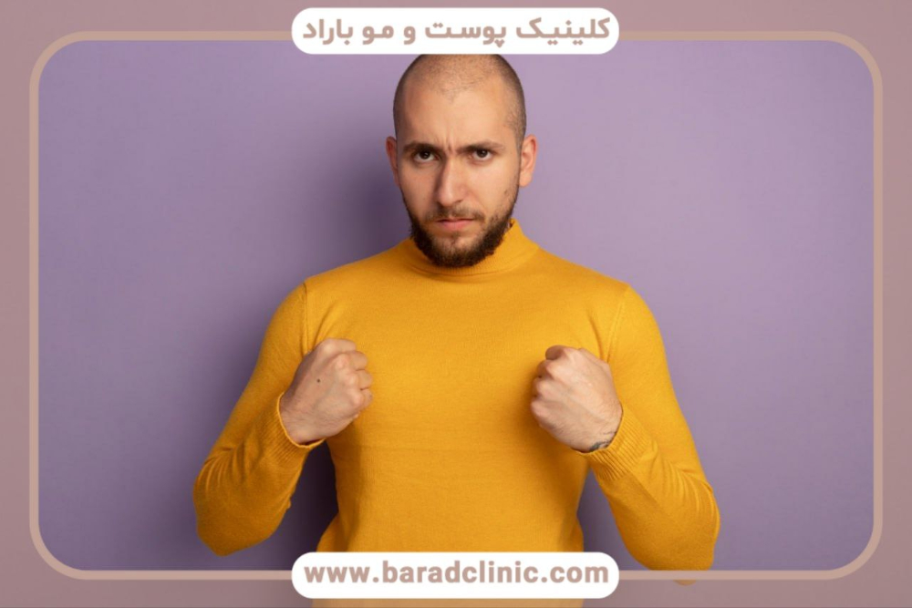 کاشت مو قبل و بعد