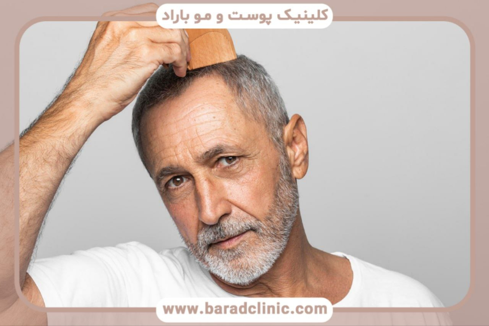 ۴۰ روز بعد از کاشت مو