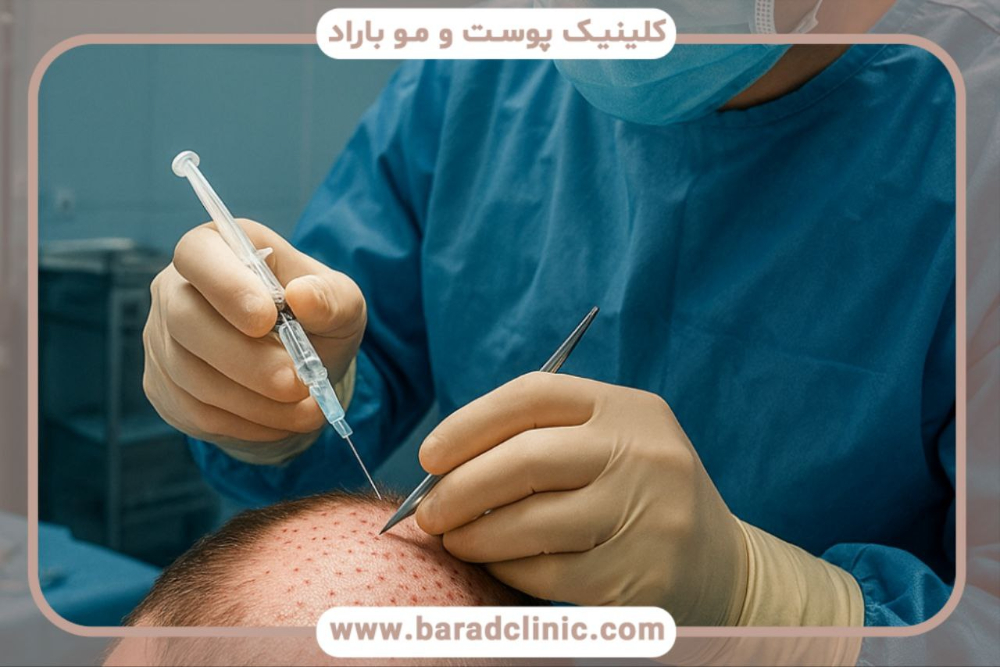 پزشک در حال آماده‌سازی ناحیه گیرنده برای کاشت مو، تزریق بی‌حسی موضعی و فیلم کاشت مو