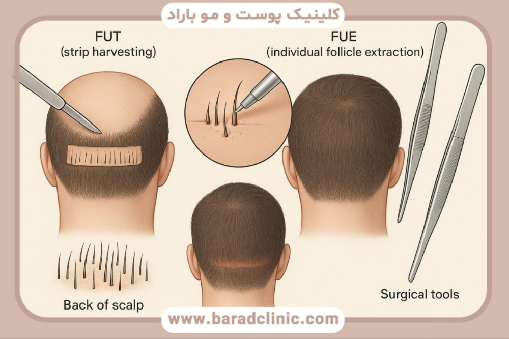 انواع روش کاشت مو در فیلم کاشت مو