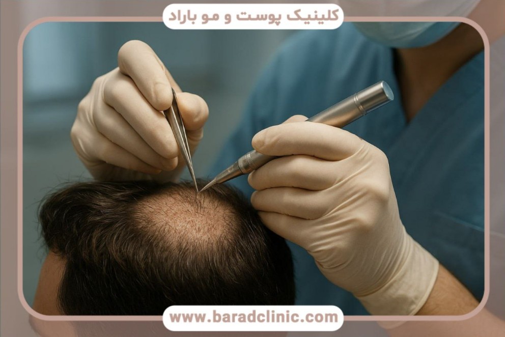 جدیدترین روش کاشت مو بدون تراشیدن مو با تکنیک No-Shave FUE