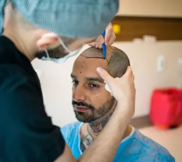 نحوه انتخاب جراح کاشت مو