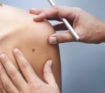 روش هایی برای از بین بردن خال گوشتی