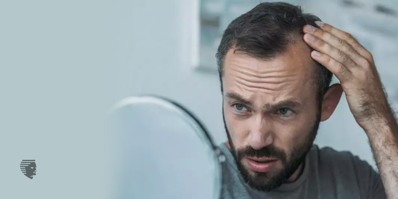 علائم ریزش موی موقت