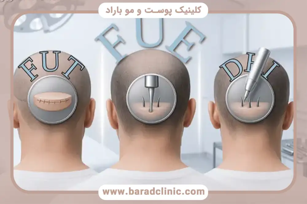 کاشت مو FUE چیست؟ راهنمای کامل روش، مراحل و مراقبت‌های بعد از عمل