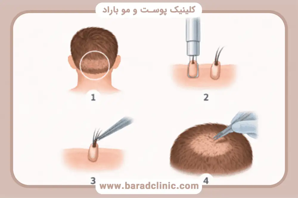 کاشت مو FUE (Follicular Unit Extraction)