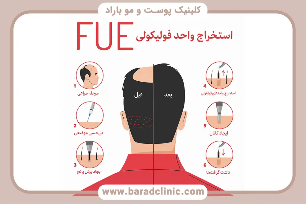 مراحل انجام کاشت مو FUE
