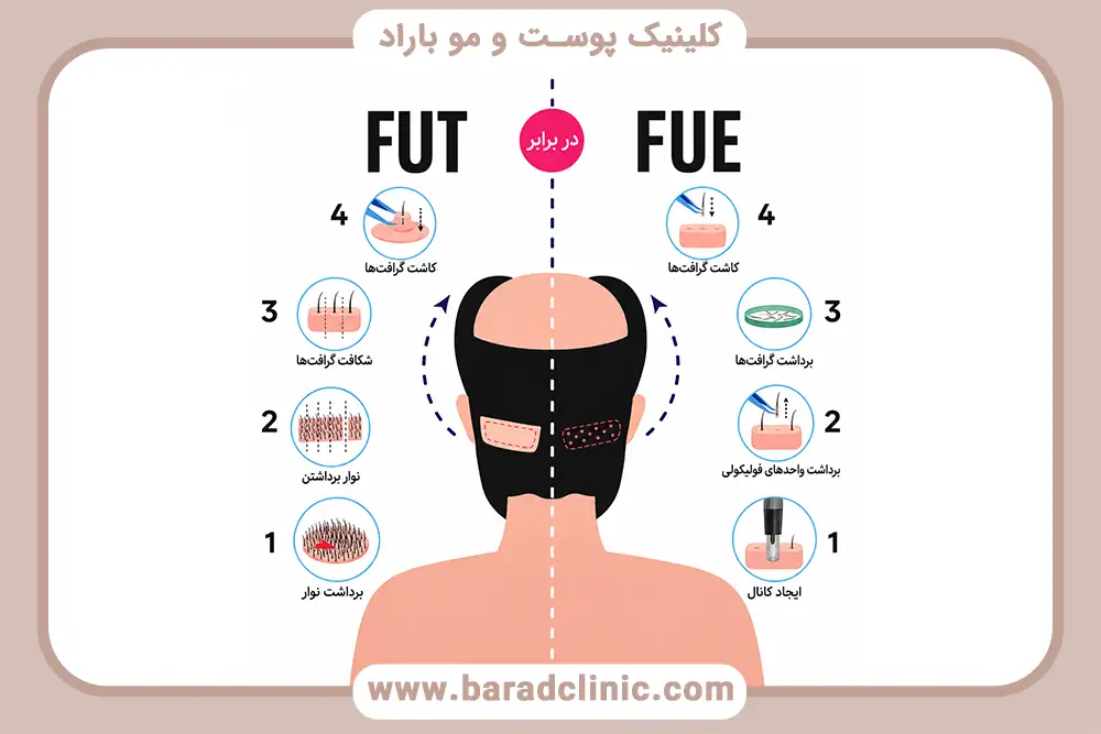 تفاوت کاشت مو  FUE , FUT