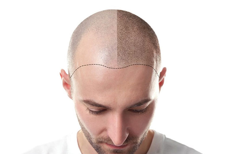 میکروپیگمنتیشن پوست سر