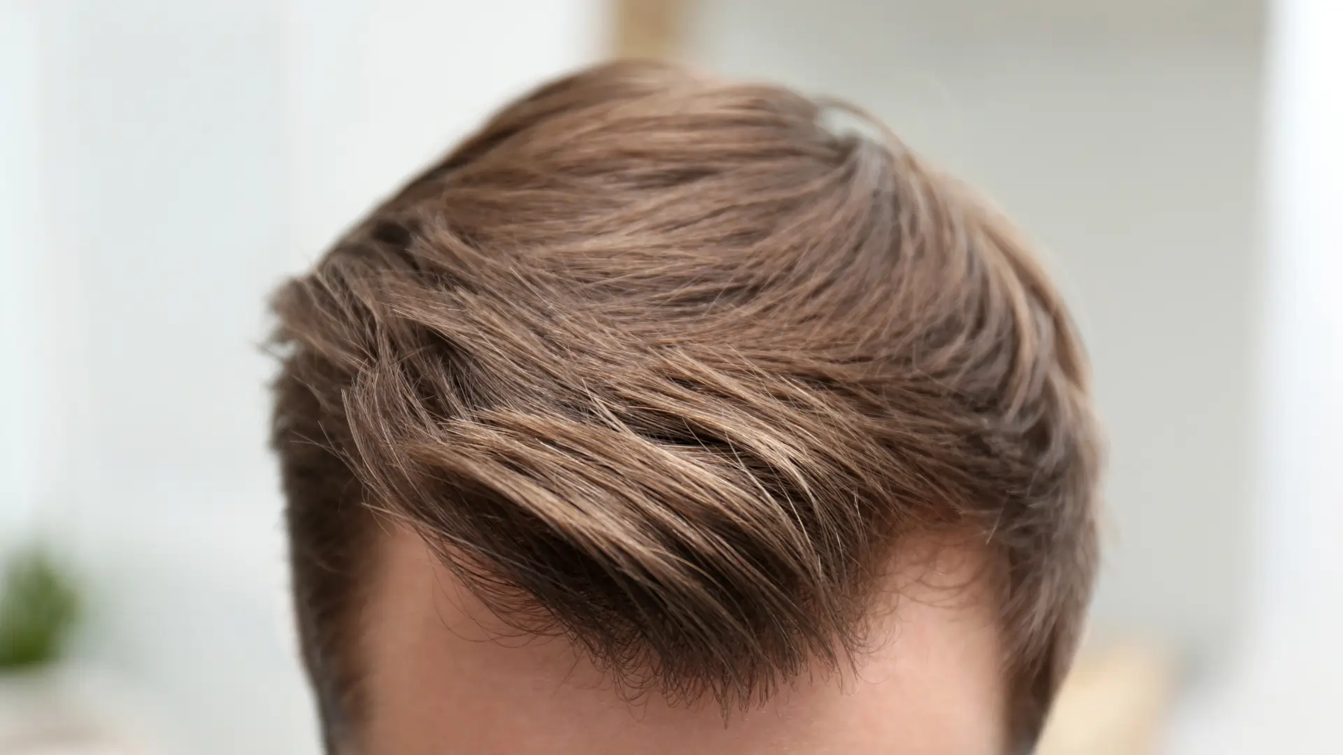 نتایج نهایی پیوند مو