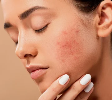 با اسکار آکنه خداحافظی کنید