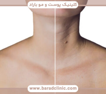 neck botox