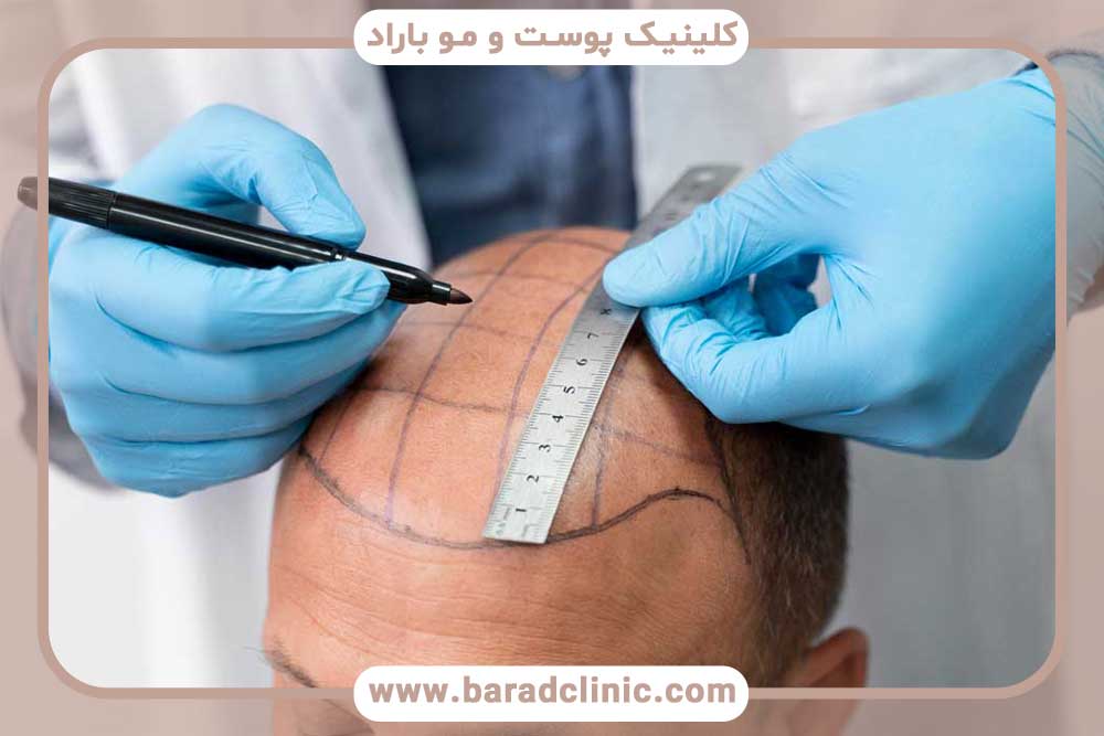 کاشت مو کلینیک پوست و مو باراد