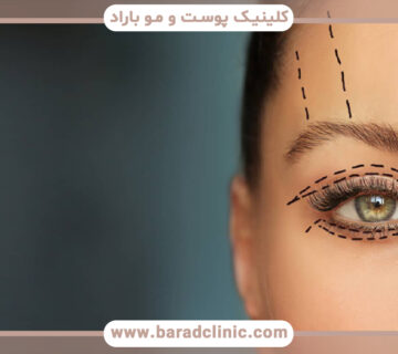 بلفاروپلاستی و اهمیت زیبایی چشمها