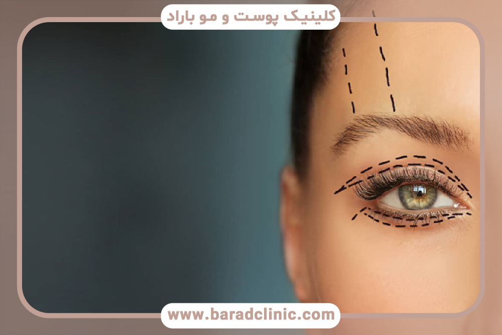 بلفاروپلاستی و اهمیت زیبایی چشم‌ها