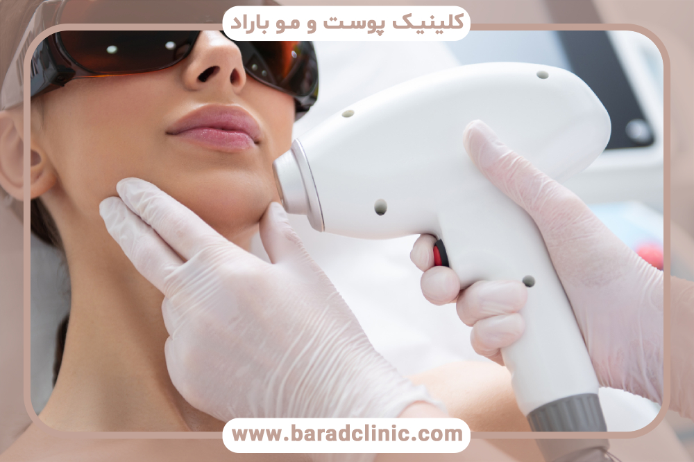 لیزر موهای زائد و مزایای آن