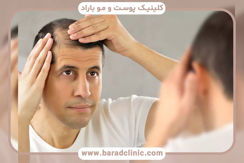 آیا کاشت مو برای افراد با ریزش مو ارثی مناسب است؟
