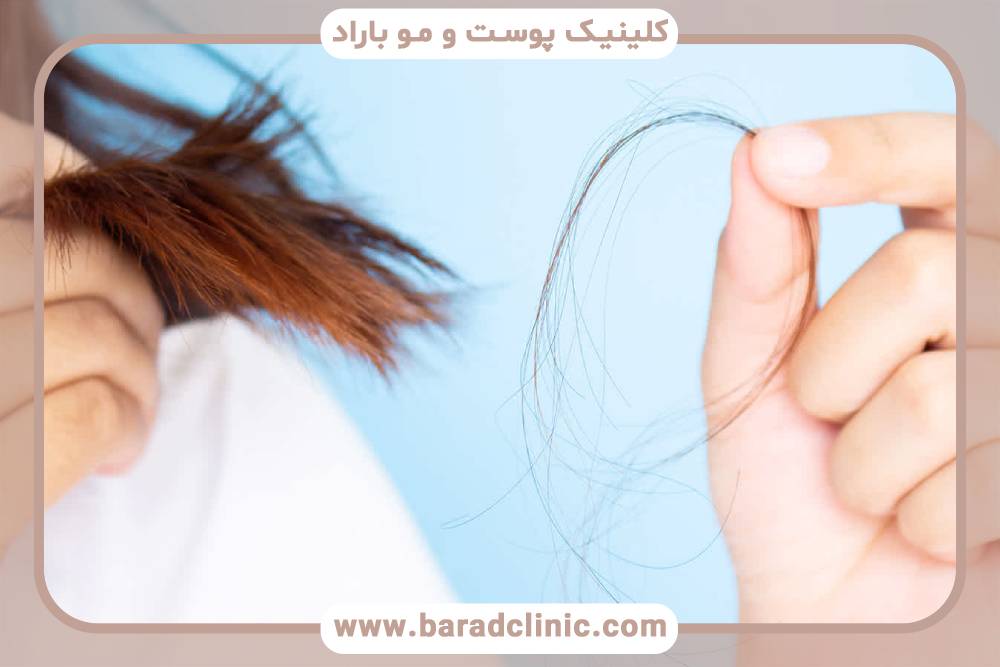 کاشت مو و تغییرات هورمونی