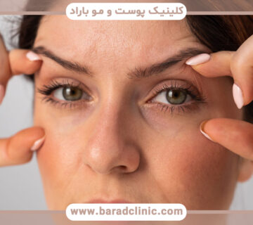 بلفاروپلاستی پلک بالا و پایین