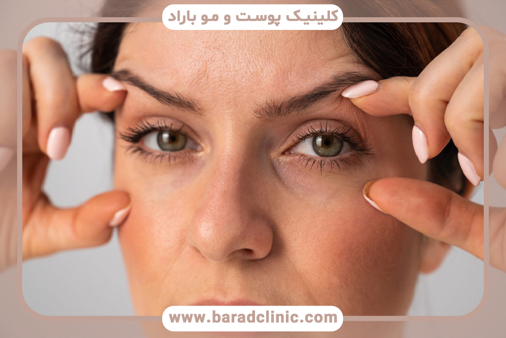 بلفاروپلاستی پلک بالا و پایین