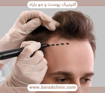مزایای و معایب کاشت مو در سنین مختلف