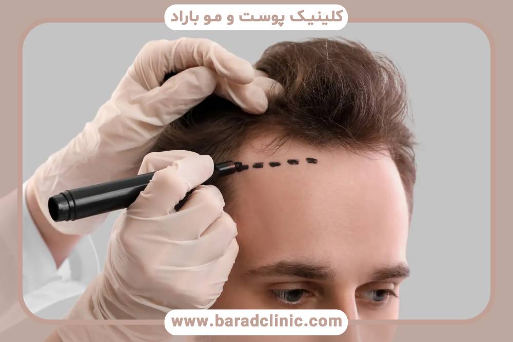 مزایای و معایب کاشت مو در سنین مختلف