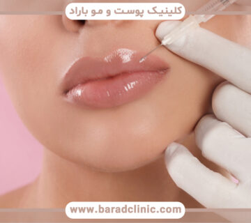 مهاجرت فیلر لب و روشهای پیشگیری