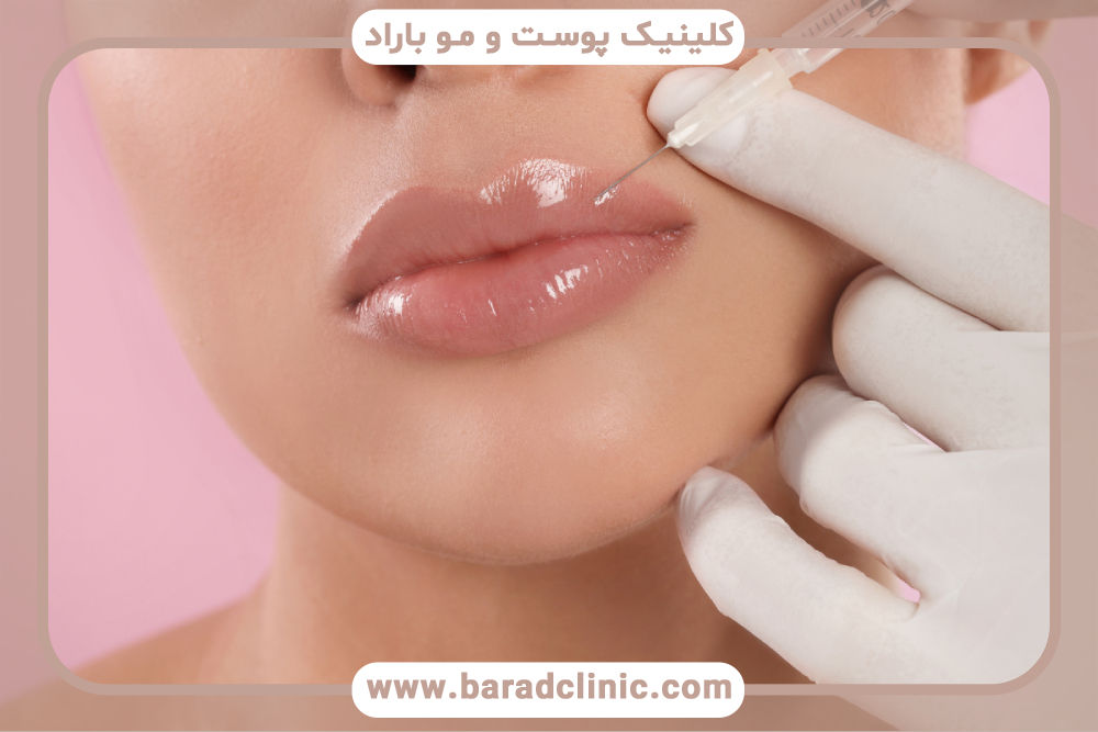 مهاجرت فیلر لب و روش‌های پیشگیری