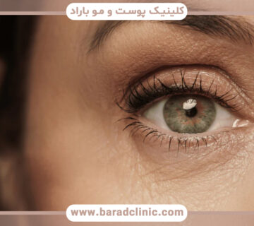 بهبود ظاهر پوست اطراف چشم