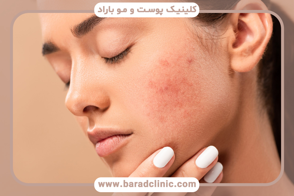 درمان اسکار آکنه