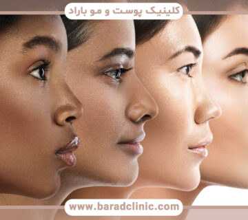 تاثیر انواع مختلف پوست و لیزر موهای زائد