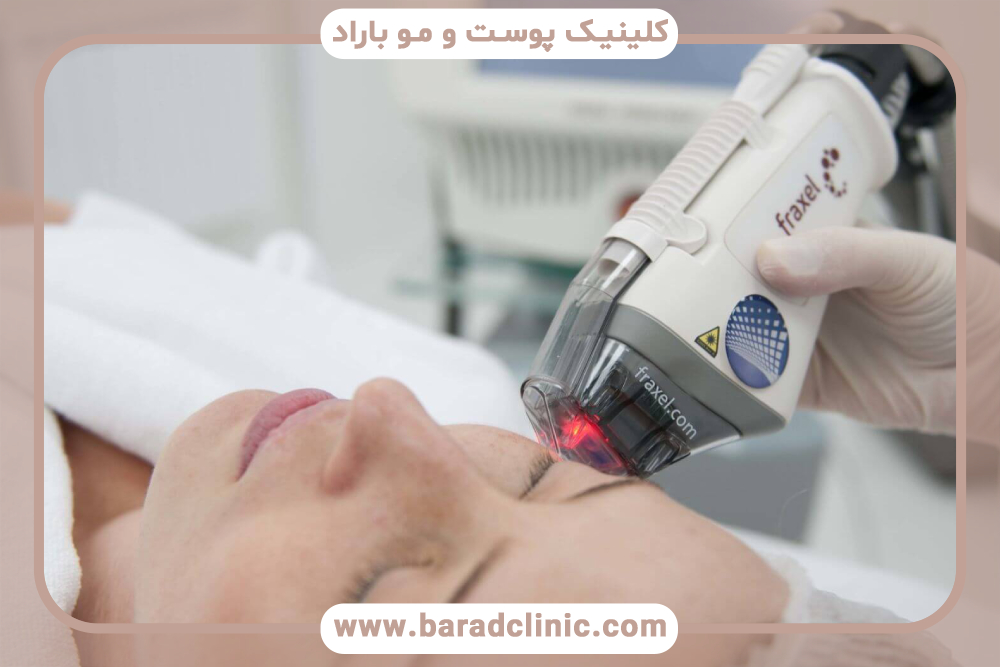 لیزر فراکسل