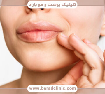 تورم فیلر لب