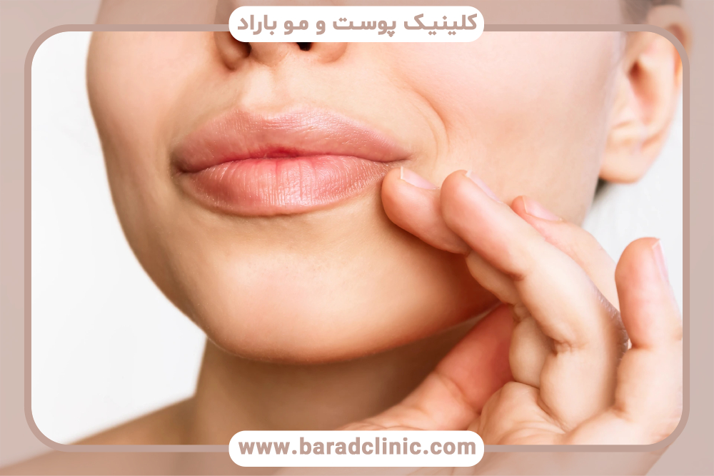 تورم فیلر لب