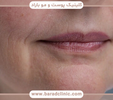 بهترین فیلر برای درمان خطوط ماریونت چیست؟