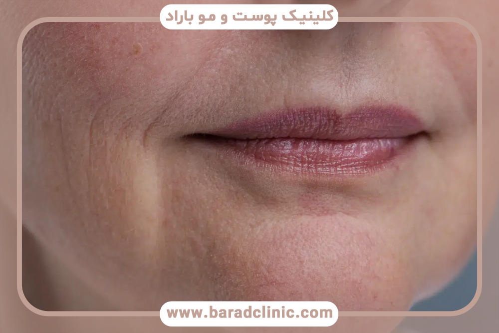 بهترین فیلر برای درمان خطوط ماریونت چیست؟